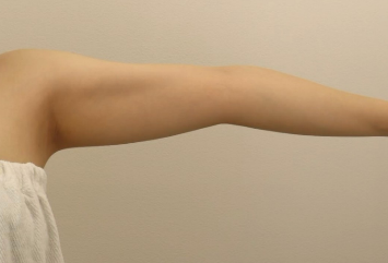 二の腕の脂肪吸引｜症例写真