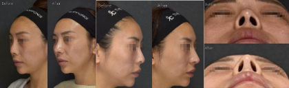 鼻整形｜矯正・機能改善｜症例写真