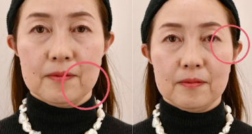 老け顔対策｜若返りの治療の症例写真