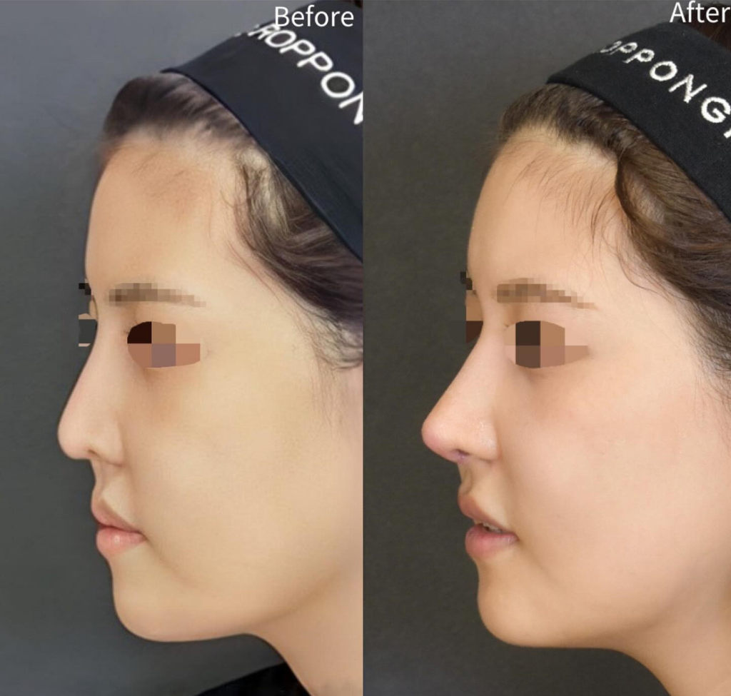 鼻の整形の種類｜鼻整形｜症例写真