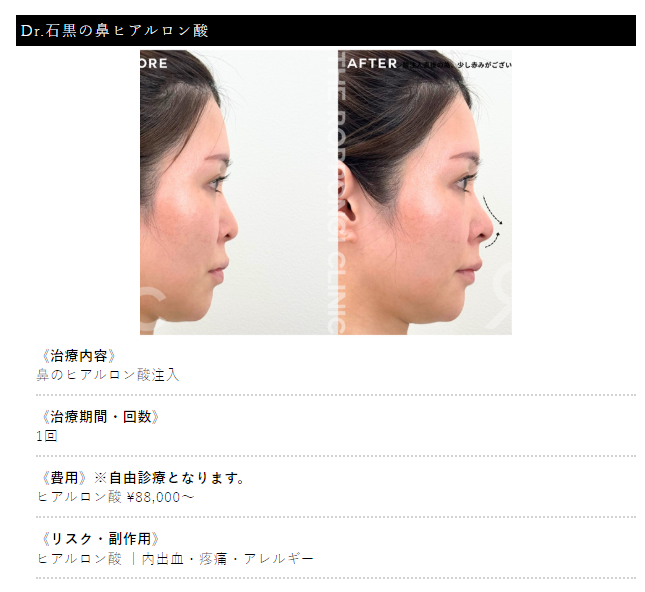 ヒアルロン酸注射