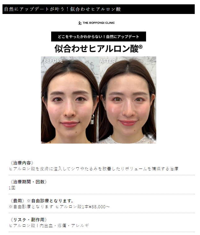 似合わせヒアルロン酸