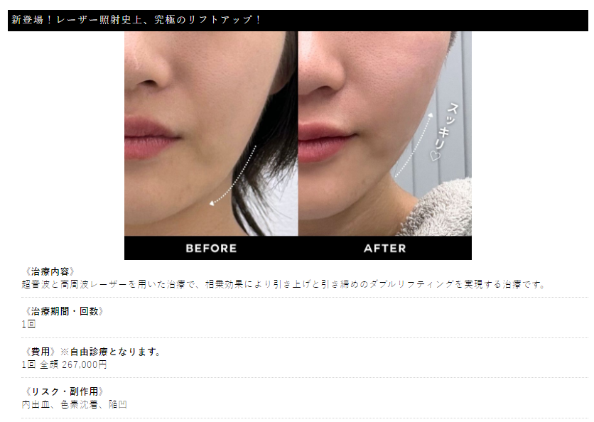 ザロクスーパーアイロンリフト