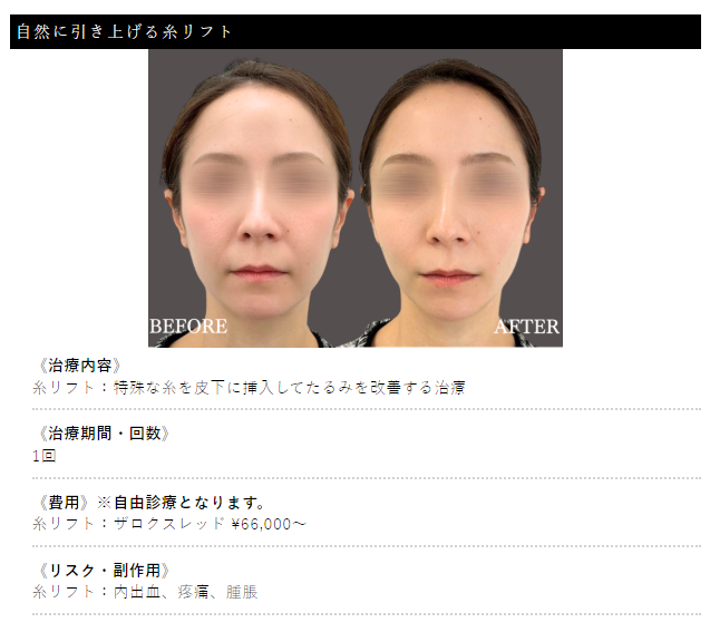 ザロク式スレッドリフト