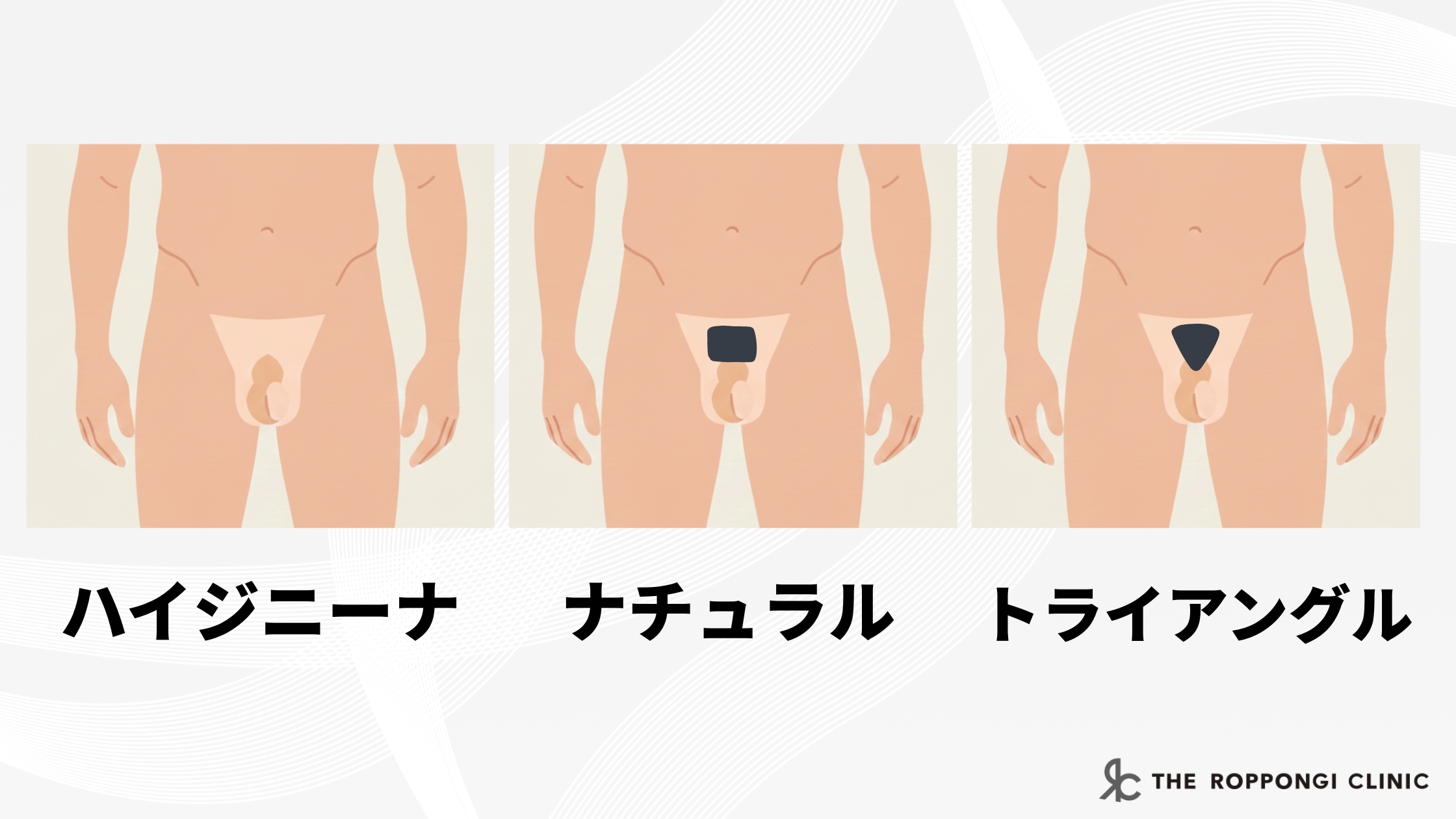 メンズVIOのデザイン説明