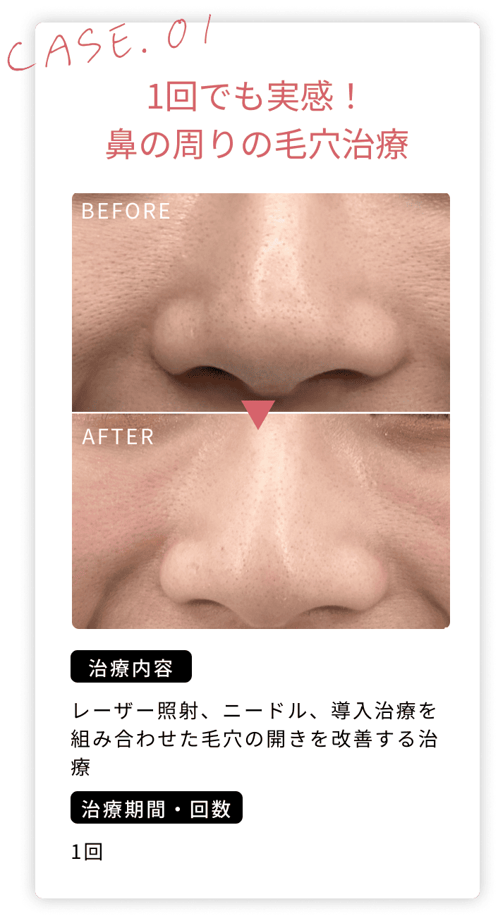鼻の周りの毛穴治療