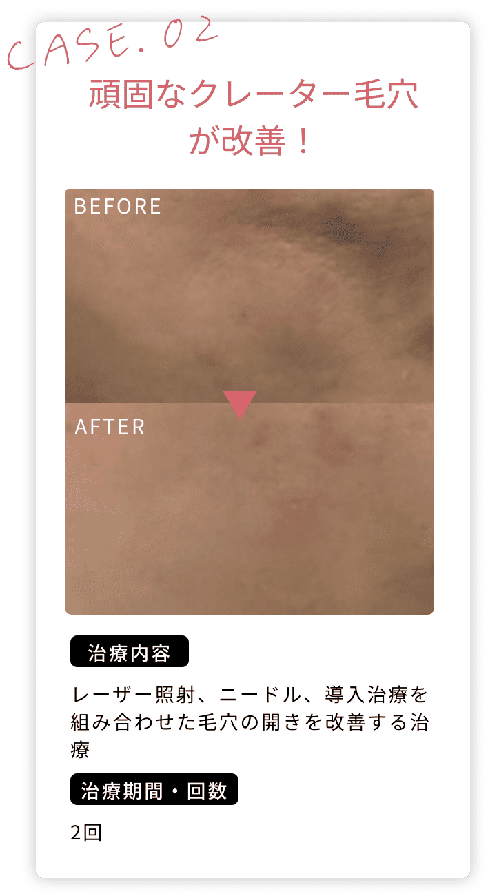 頑固なクレーター毛穴が改善