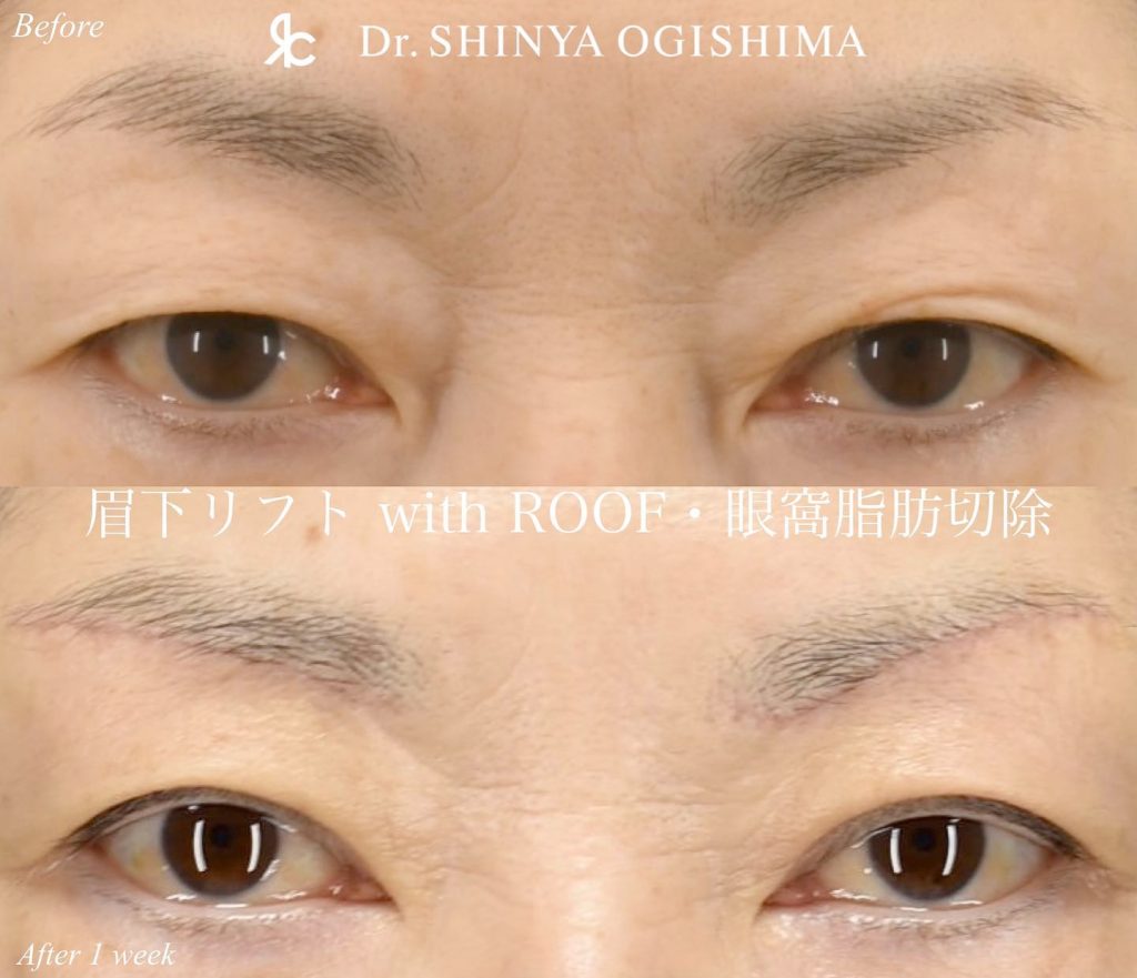 眉下リフト