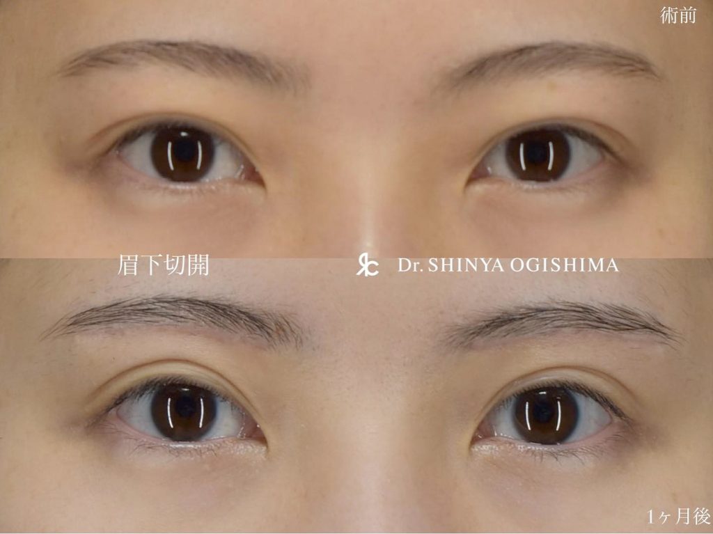 眉下リフト