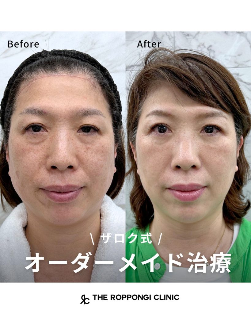 【ザロク式オーダーメイド治療】脱脂＋ザロク式似合わせヒアルロン酸®︎