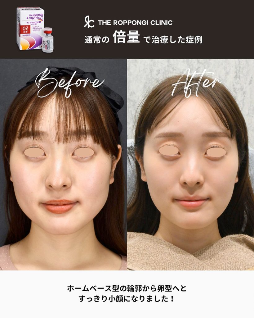 エラボトックスで小顔に！