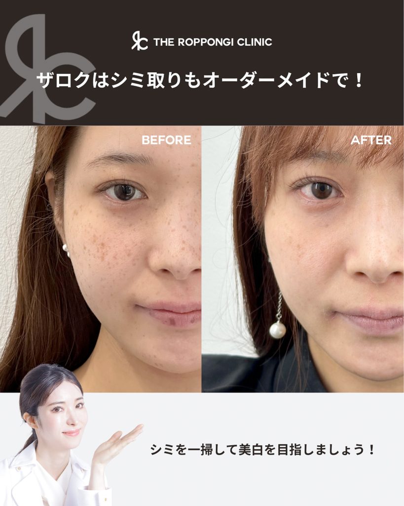 シミ取り（ピコレーザー）