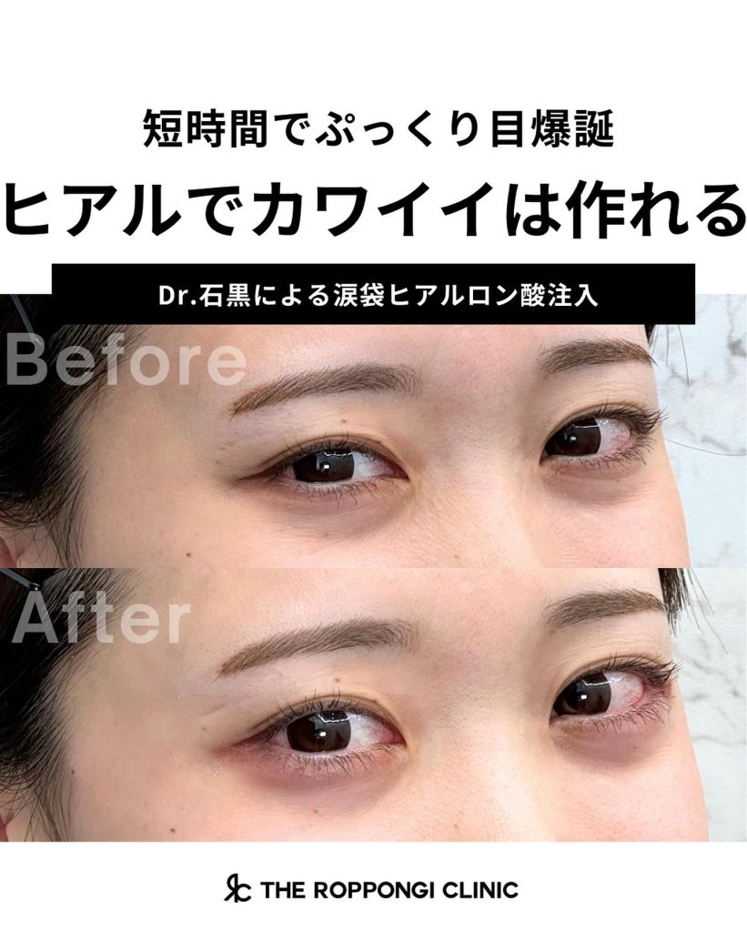 短時間でぷっくり目爆誕！ヒアルでカワイイは作れる
