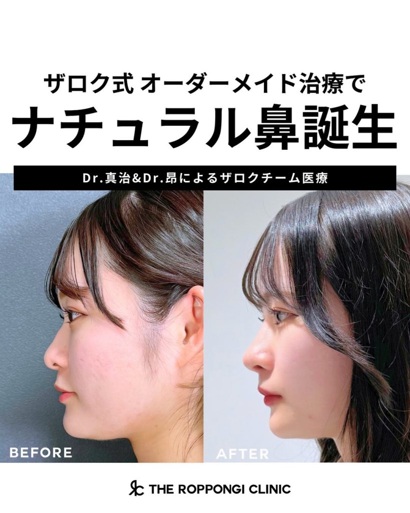 ナチュラル鼻誕生