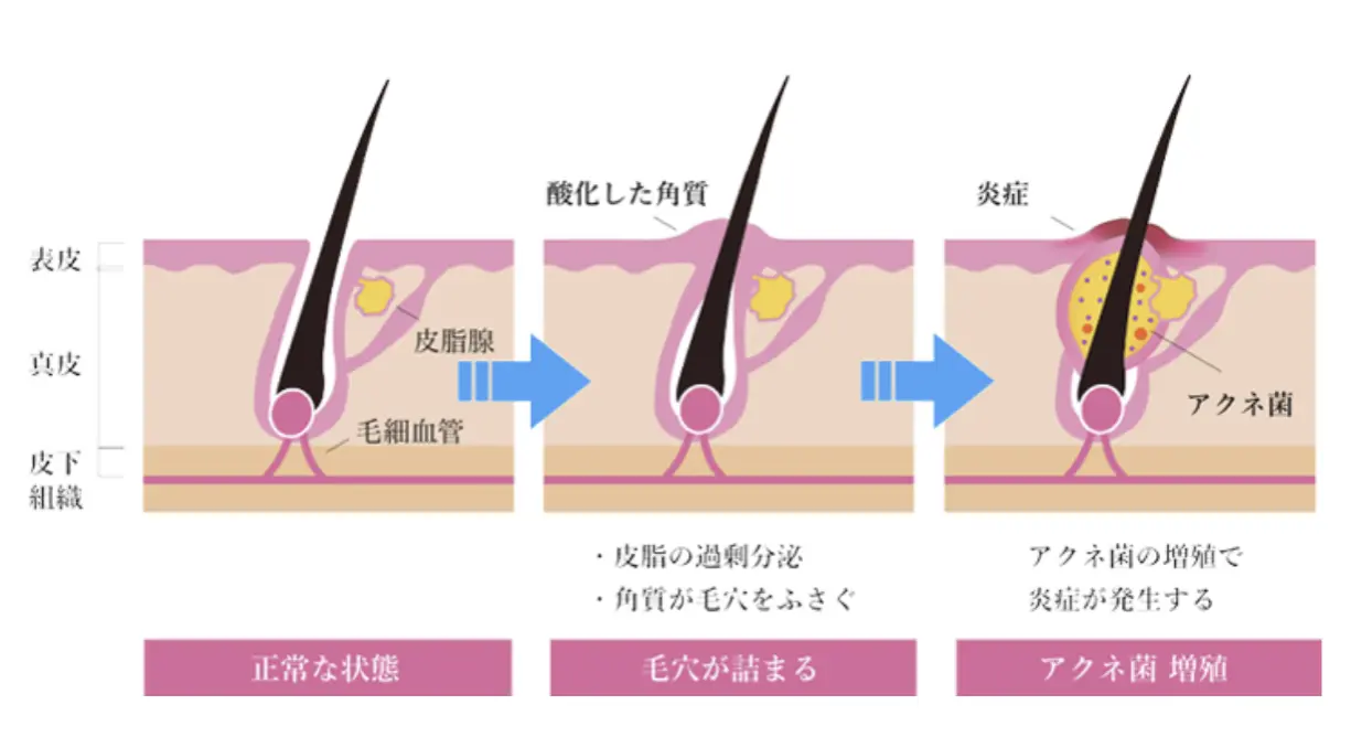 ニキビ圧出