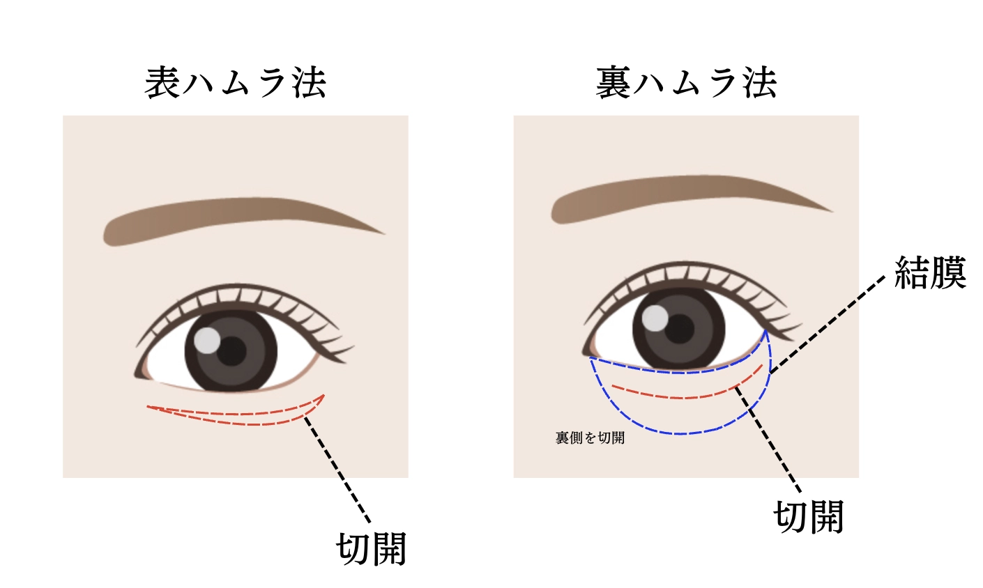 ハムラ法