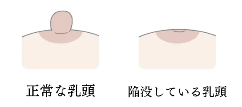 陥没乳頭