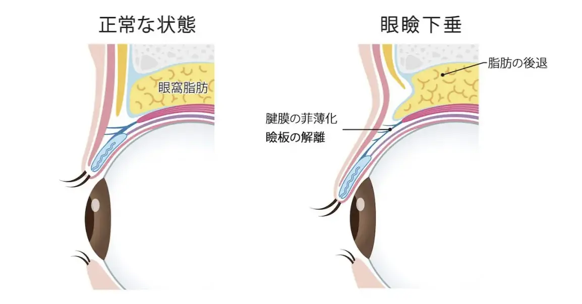 切らない眼瞼下垂