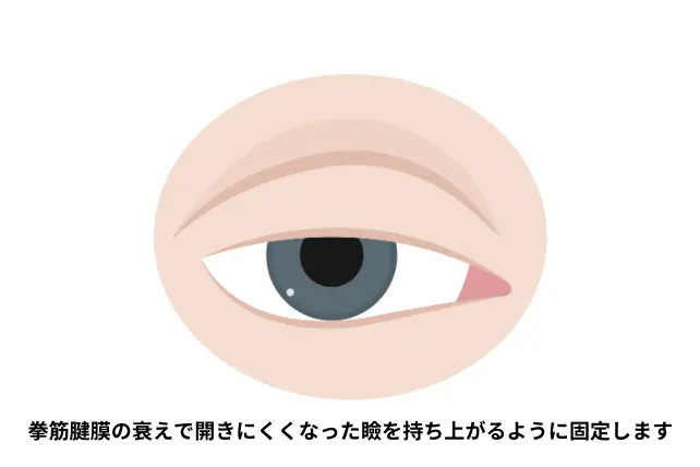 眼瞼下垂
