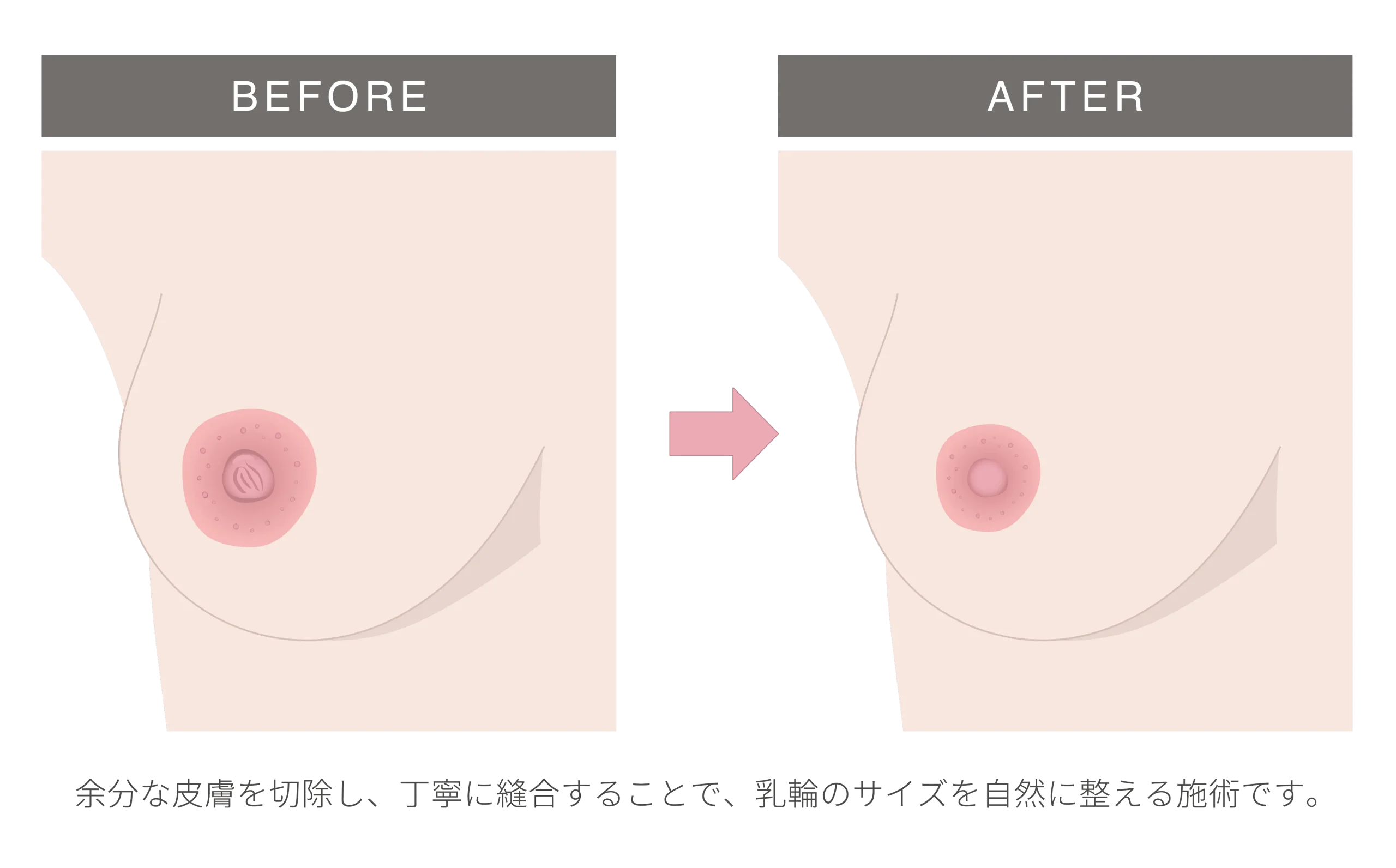 乳輪縮小
