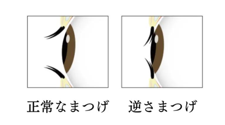 逆さまつげ修正