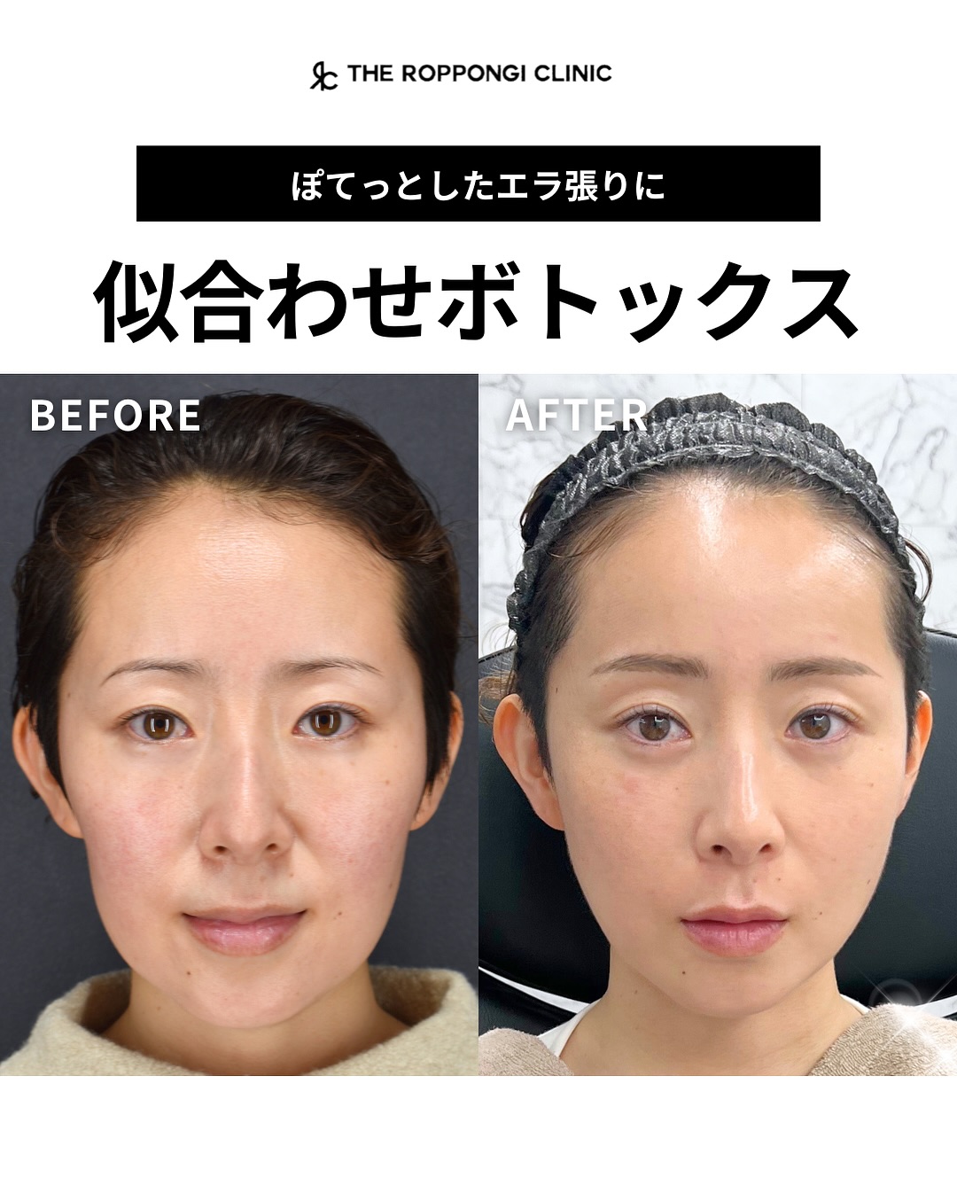 似合わせボトックス
