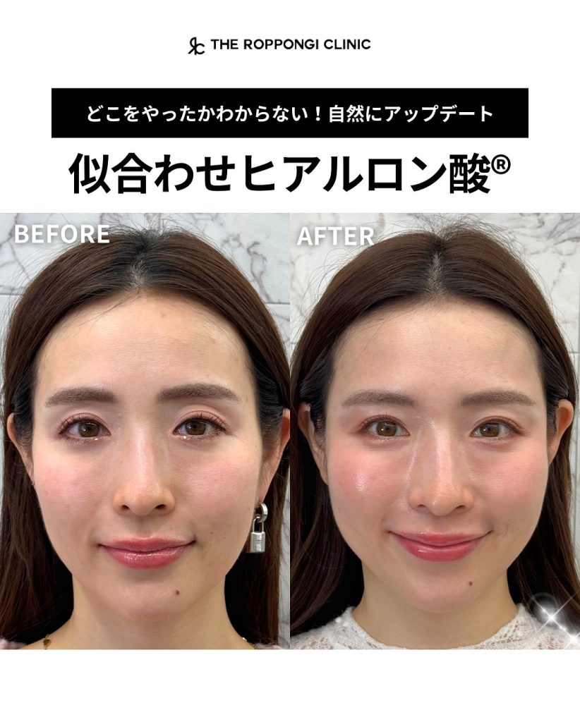 自然にアップデートが叶う！似合わせヒアルロン酸