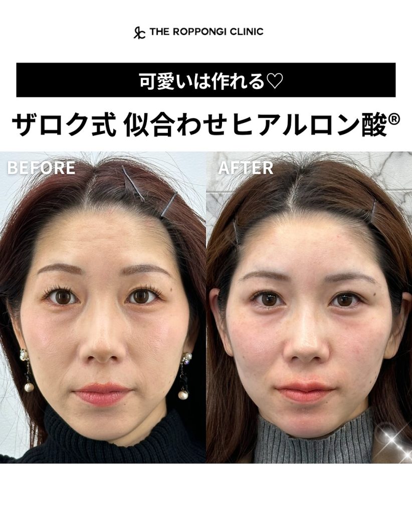似合わせヒアルで可愛いは作れる