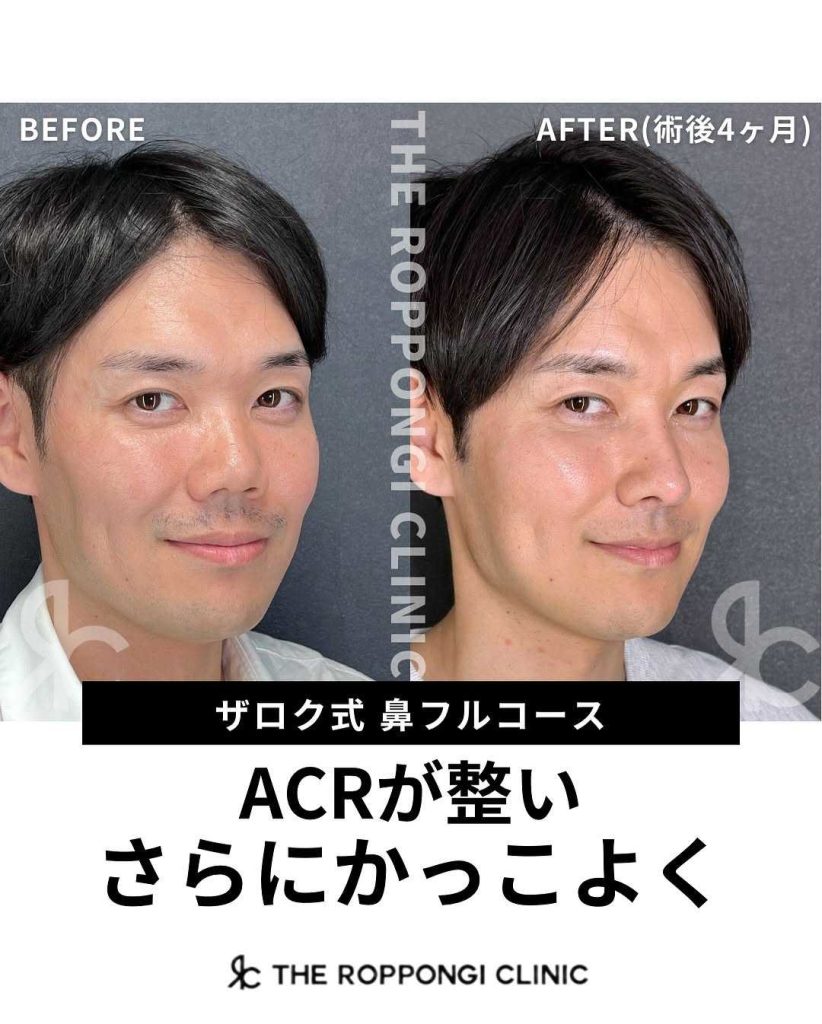 ACRが整いさらにかっこよく
