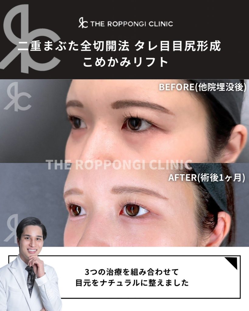 二重全切開でもこの自然さ！