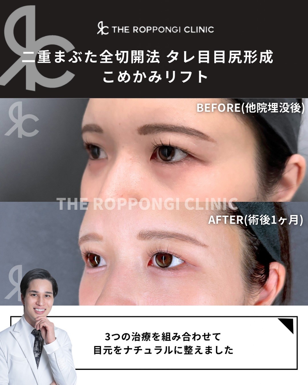 二重全切開でもこの自然さ！