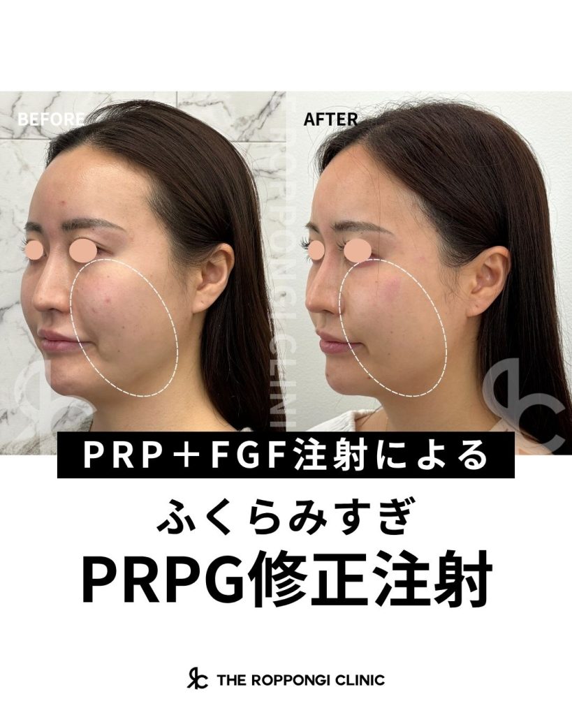 注射後のシコリが気になる…修正注射でここまで改善！
