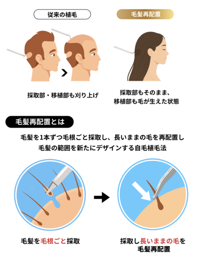 ザロクの毛髪再配置