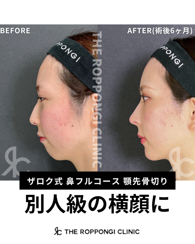 「鼻フル×顎先骨切り」で別人級の横顔に
