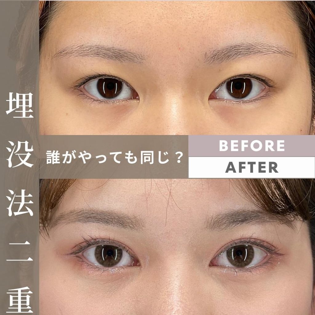 埋没法は“誰がやっても同じ”ではない ― デザイン力で差が出る理由
