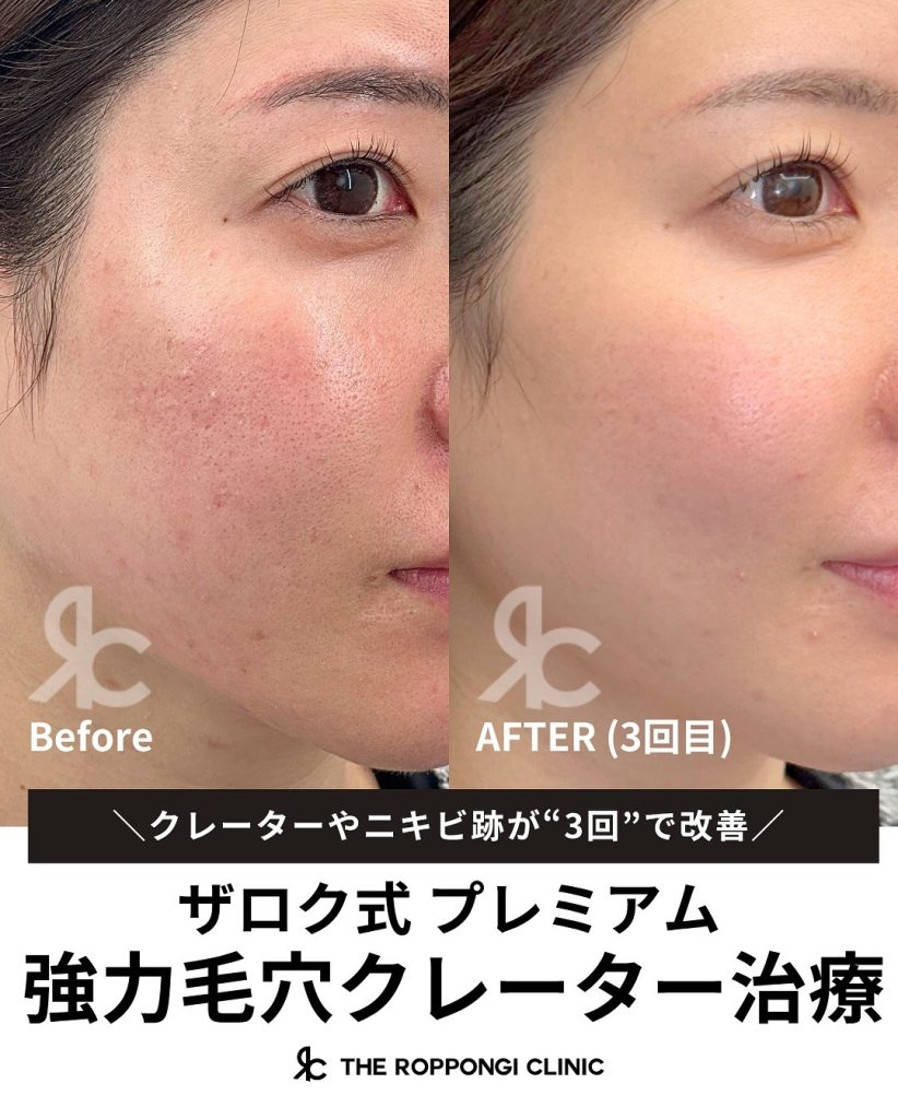 ザロク式 プレミアム強力毛穴クレーター治療