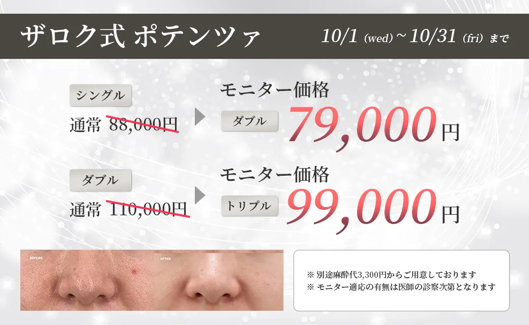 ザロク式 ポテンツァ