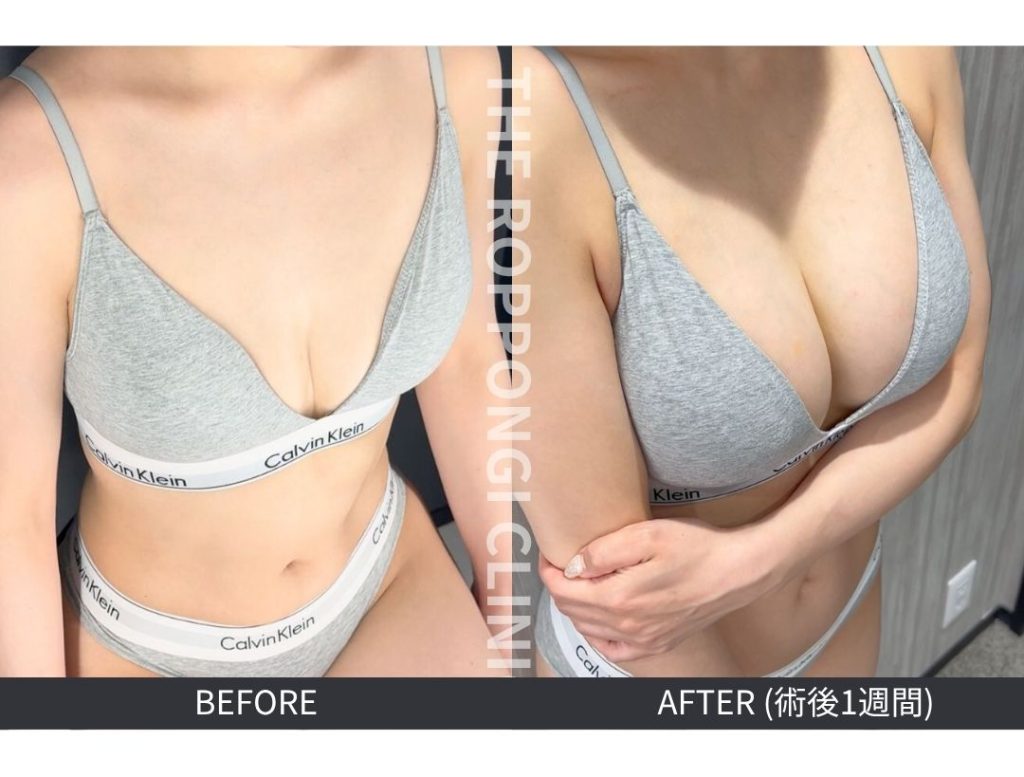 術後1週間でこの仕上がり