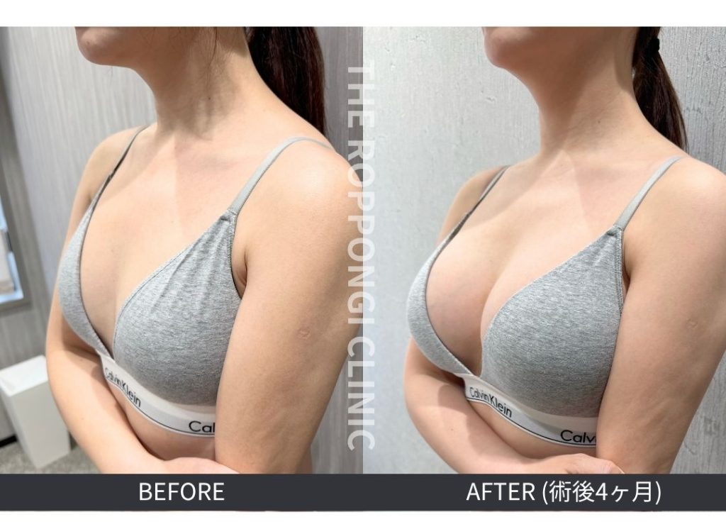 ふっくらぷるんバスト