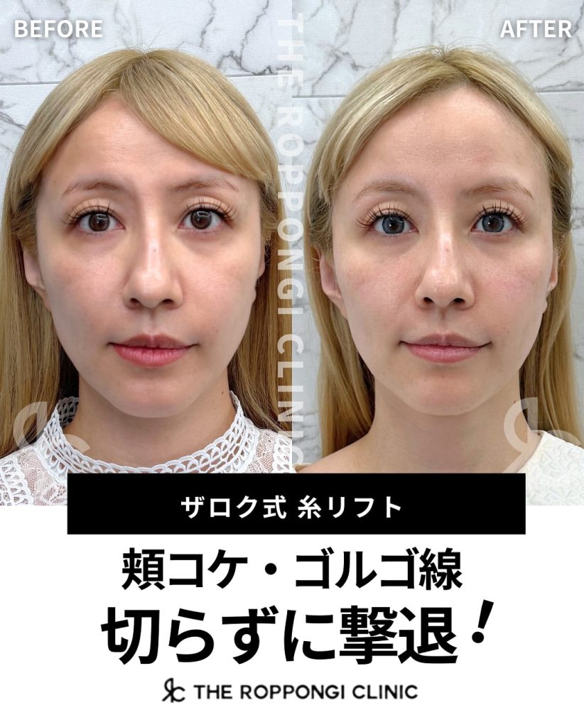 糸リフトで頬コケ・ゴルゴ線を切らずに撃退