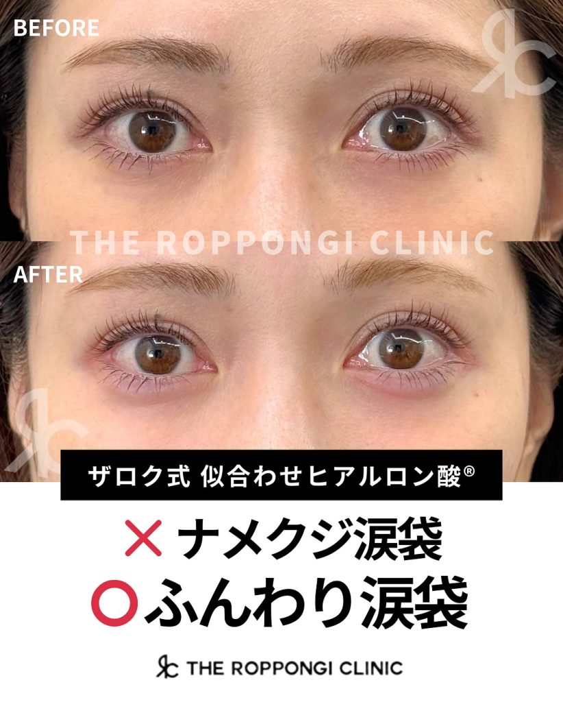 ザロクの“似合わせヒアル”で、ふんわり自然な涙袋を