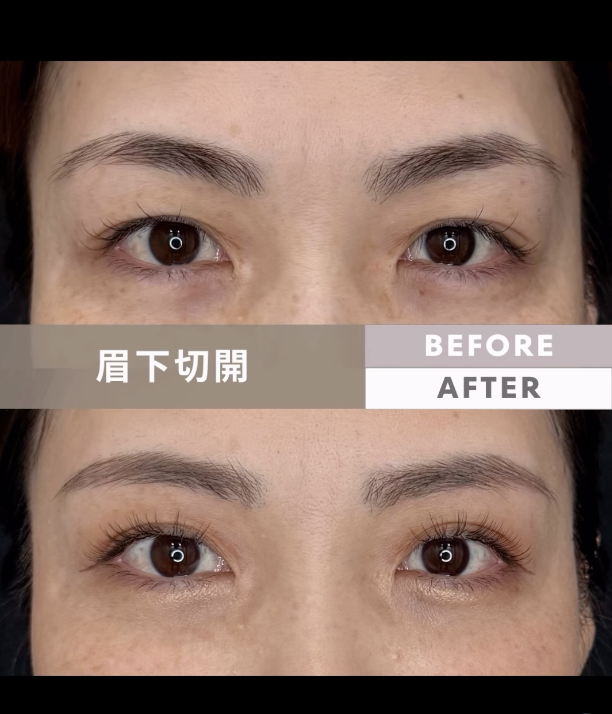 眉下切開の差が出るポイント