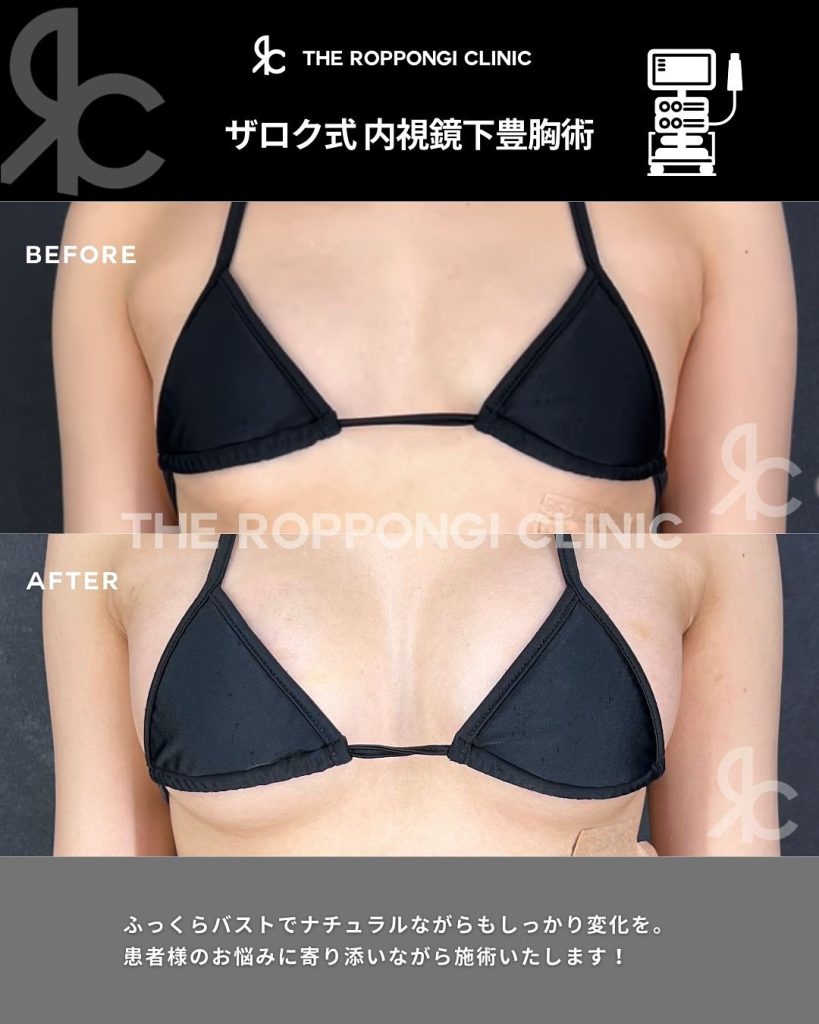 普通の豊胸と何が違うの？内視鏡下豊胸