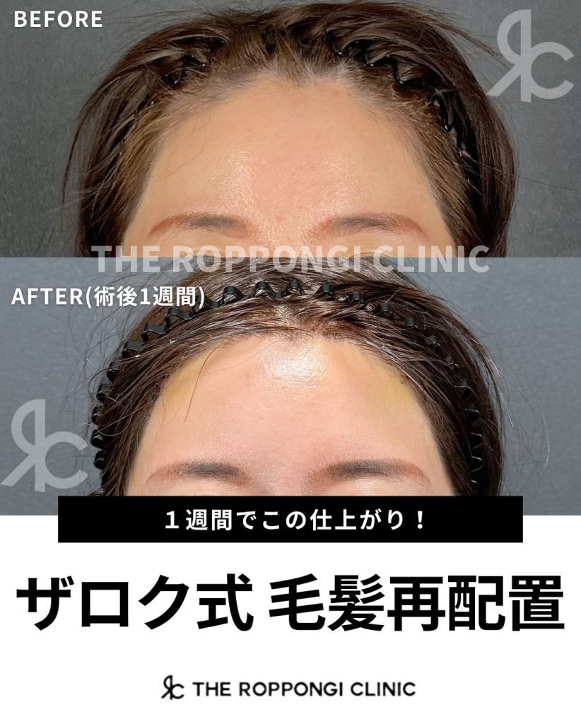 ザロク式 毛髪再配置