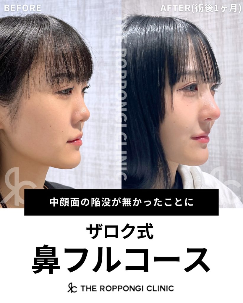 ザロク式 鼻フルコース
