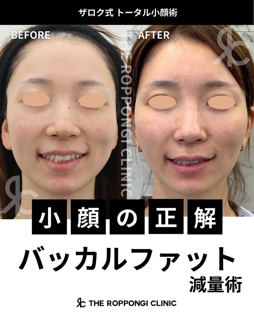 バッカルファット減量術で小顔に