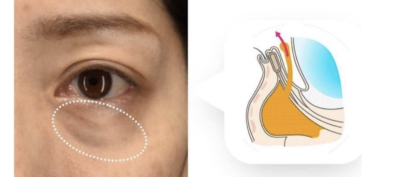 プレミアム脱脂術